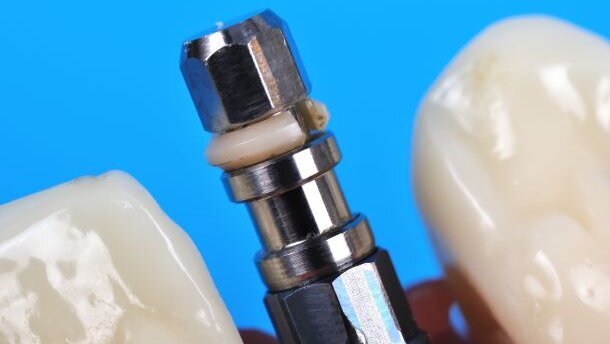 Fronttandvervanging tot 23 jaar vergoed per 2017