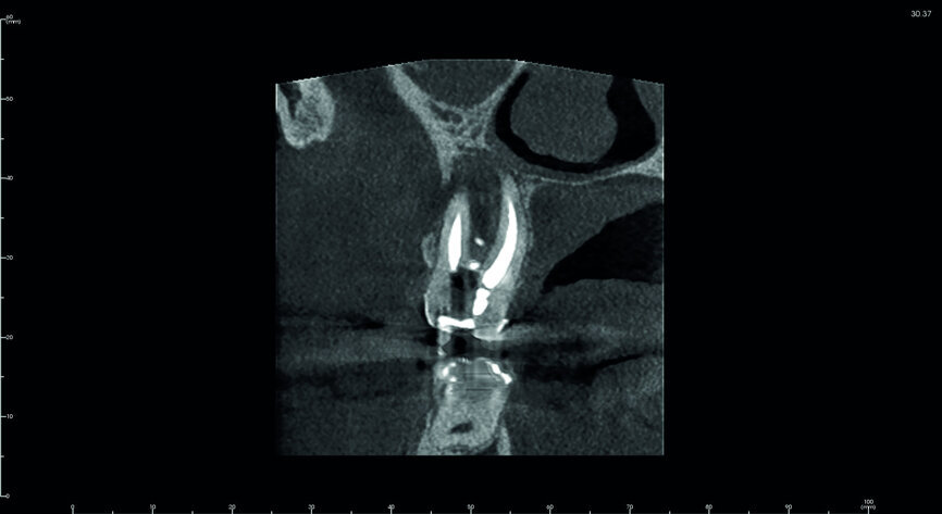 Fig. 6: Pre-op CBCT scan, detailed section of the maxillary second molar.