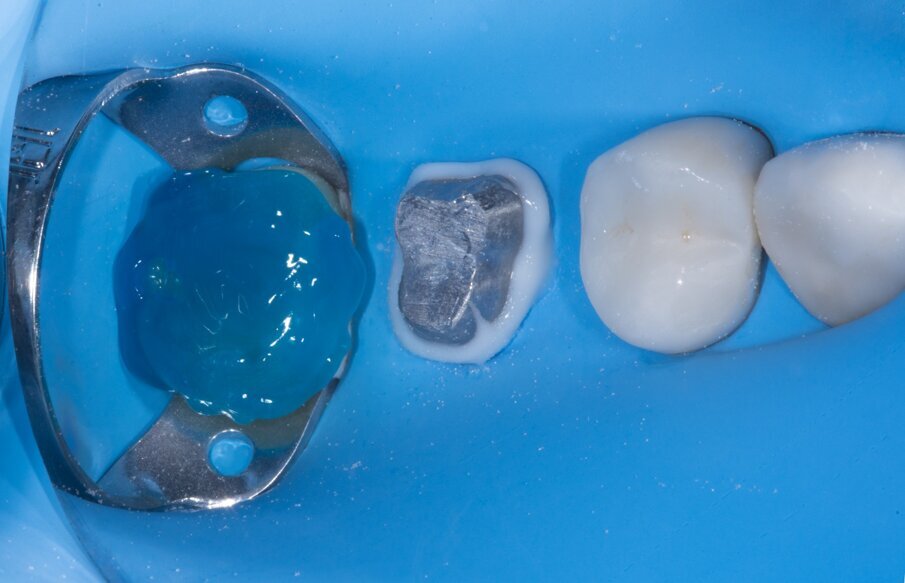 Fig. 10: Etching with phosphoric acid (etch and rinse approach). 