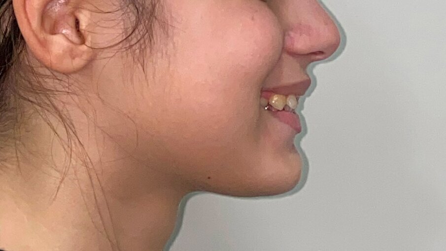 Fig. 4_Profilo sorriso pre-trattamento.