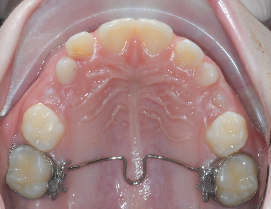 Fig. 7_Barra palatale, exo “D” ed eruzione 1.4-2.4. 
