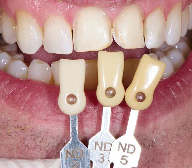 Fig. 4: Determining the tooth shade of the prepared teeth