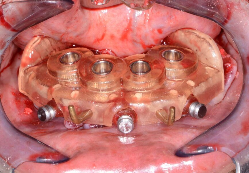 Fig. 14: Positioning implant surgical guide.