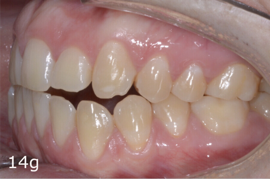 Figs. 14a–h: Intra-oral comparison of the situation (a, d, e & h) before and (b, c, f & g) after treatment.