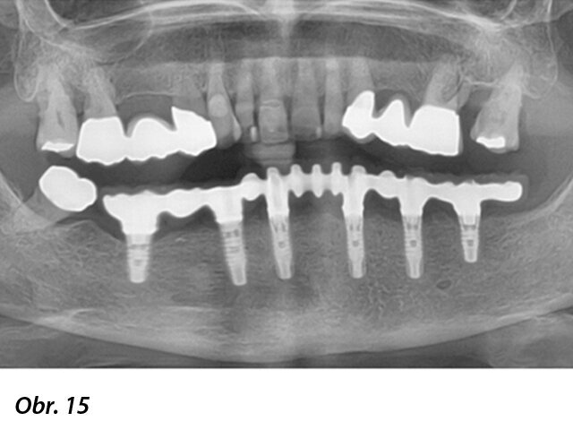 Panoramatický RTG snímek po nasazení definitivní CAD/CAM fixní náhrady.
