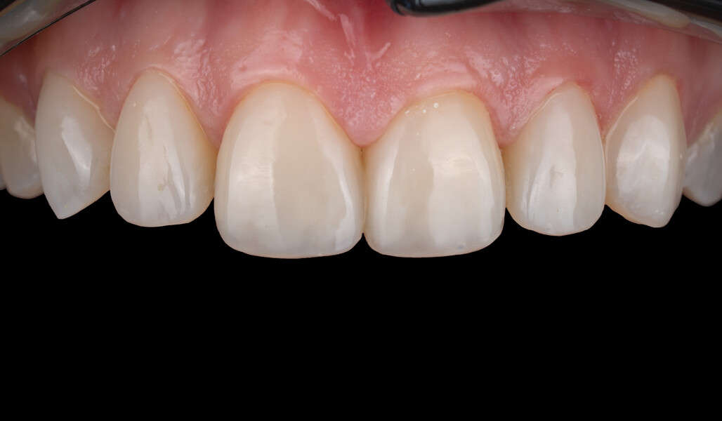 Fig. 9a: Final treatment outcome. Intra-oral frontal view.