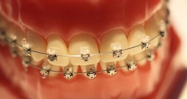 Czas noszenia aparatu ortodontycznego można skrócić