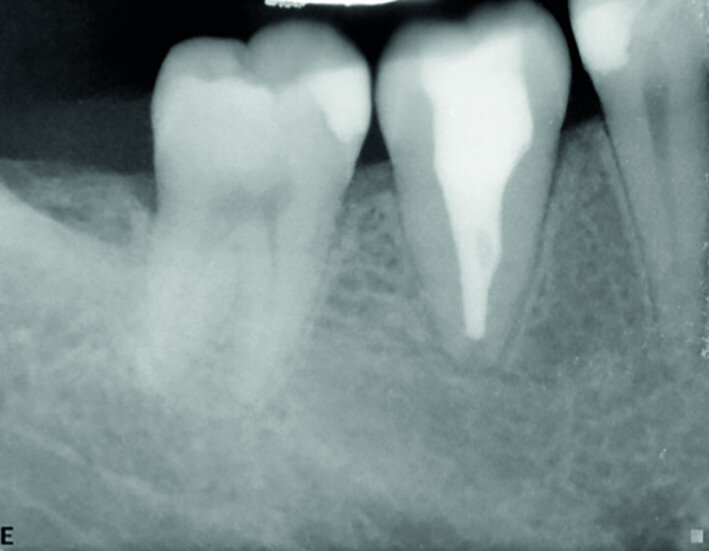 Fig. 16b: Radiograph at the one-year recall.