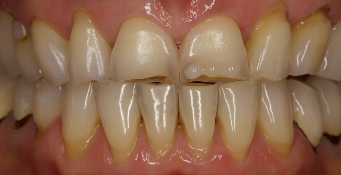 Fig. 8: Composite buttons applied to the left central incisor for shade validation.