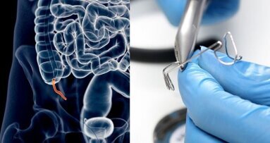 Blindedarmontsteking door orthodontische draad