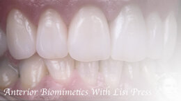 Bill Marais, RDT: Anterior Biomimtic Course With Lisi Press. hands-On Course