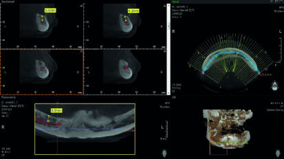 Digitising your implant practice