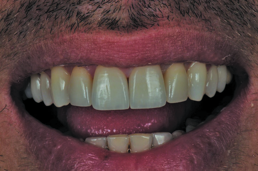 Fig. 10: Aspect after try in.