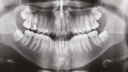 Stěsnání a protruze léčené nestandardními extrakcemi