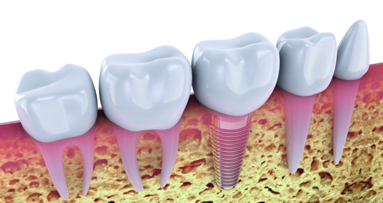 CBCT zones of the jaw - Bone quality related to implant location