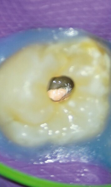 Figs. 8a-c : Entrées des canaux radiculaires obturées et plancher de la cavité pulpaire nettoyé. (a) Vue palatine, (b) vue mésio-vestibulaire et (c) vue disto-vestibulaire. 