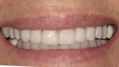 Er:YAG laser-assisted removal and recementation of a malpositioned lithium disilicate veneer