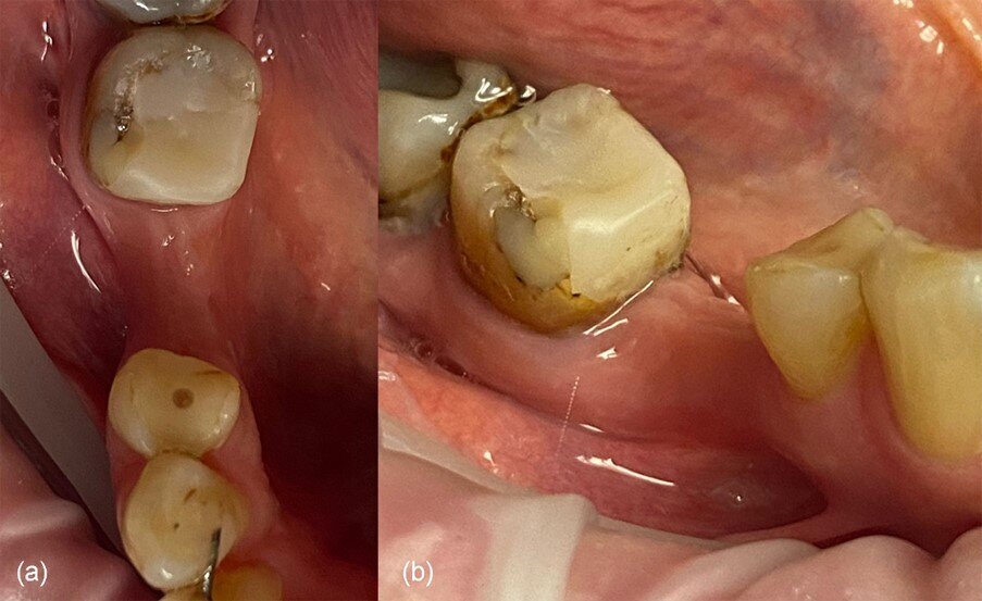Fig. 2_Situazione iniziale del sito 46: a) vista occlusale, b) vista vestibolare.