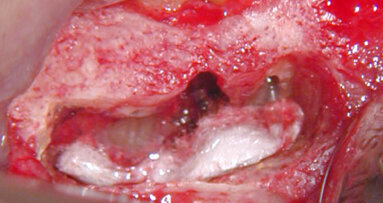 Apical microsurgery: access and crypt management (Part 3)