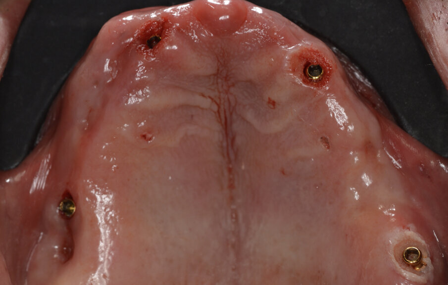 Fig. 13_OT Equator inseriti al tempo della chirurgia.