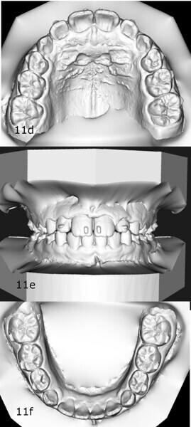 Figs. 11d–f: Comparison of the models at the (a–c) start and (d–f) end of treatment.