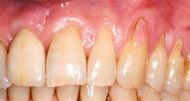 El 72% de los adultos mayores presenta recesión gingival