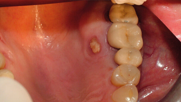 MRONJ del palato: case report