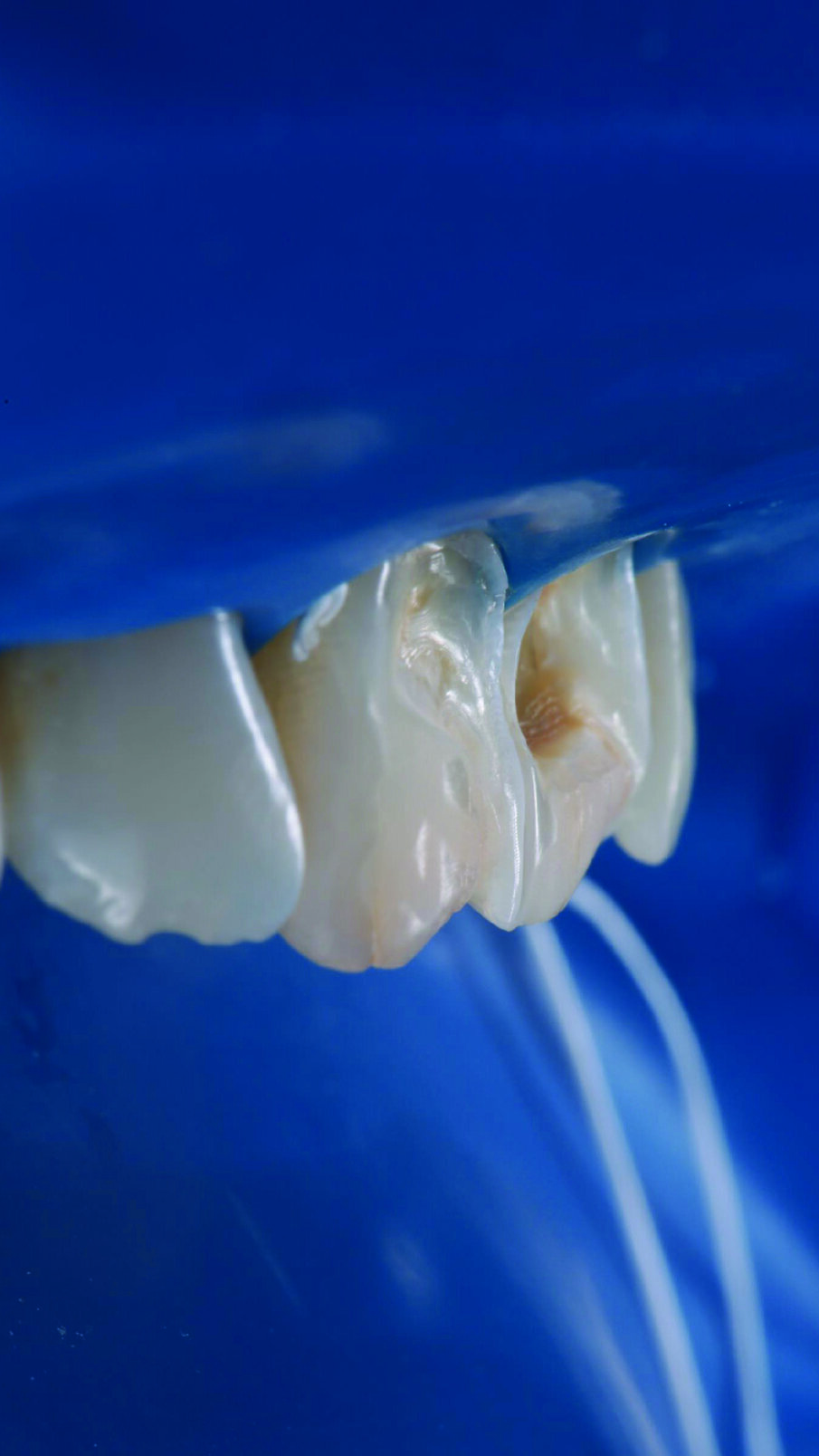 Lateral view of the anterior teeth revealed the depth of the lesions on the vestibular surfaces.