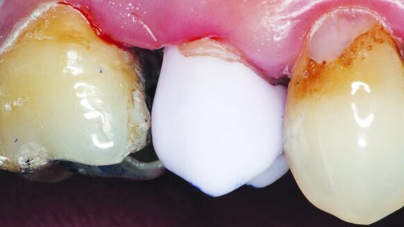 Simple and efficient crown fabrication with an advanced CAD/CAM system