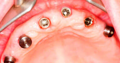 Anche nei pazienti diabetici gli impianti possono avere un buon successo