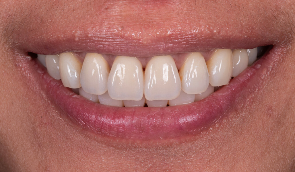 Fig. 11: Aesthetic treatment outcome.