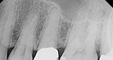 Troubleshooting calcified canals: clinical case review
