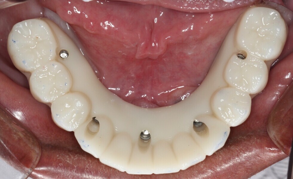 Fig. 23: Occlusal view of the complete mandibular try-in Flexcera Smile duplicate of the final prosthesis.
