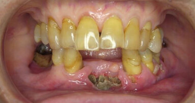 Bisfosfonaten verhogen risico op osteonecrose in kaak