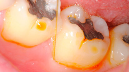 Terapia fotodinamica nelle perimplantiti: un’interessante opportunità?