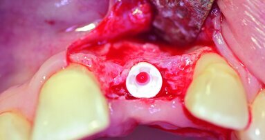 Single-tooth restoration using an all-ceramic implant solution