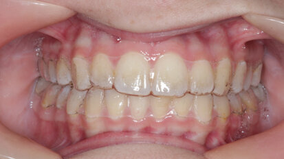 Boosting facial aesthetics through a hybrid approach of the Carriere Motion appliance and Reveal clear aligners