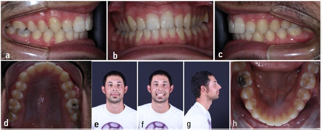 Figs. 25a–h: (a–e) Final intra-oral and (f–h) extra-oral photographs.