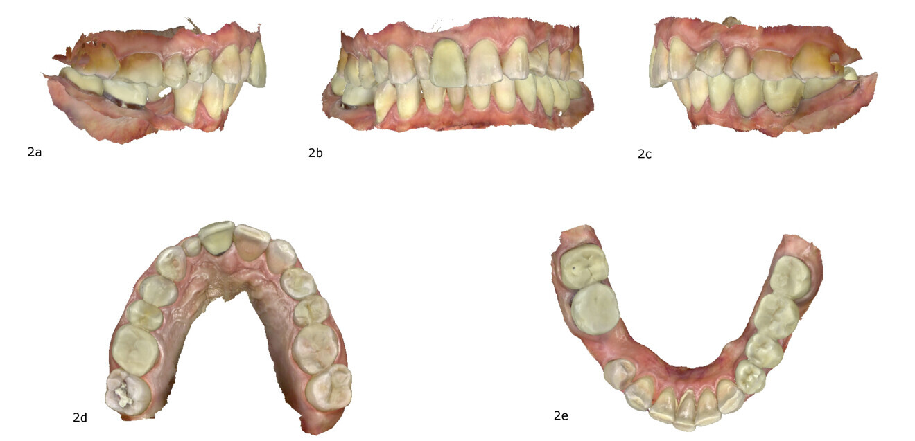 Figs. 2a–e: Intra-oral scan with iTero (Align Technology).