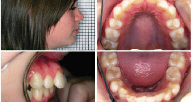 Recidiva: problém, o kterém se nikomu nechce diskutovat. Recidiva zůstává Achillovou patou ortodoncie, ale je skutečně tak těžké se o ní bavit?