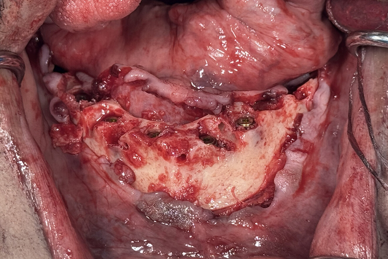 Fig. 16b: Facial view of the mandibular implants placed in the reduced ridge with residual extraction sockets.