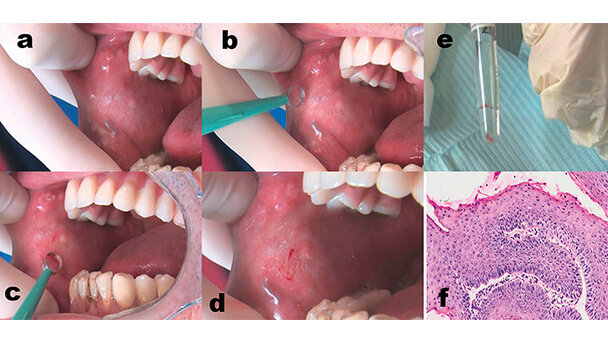 La microbiopsia per gli odontoiatri un ausilio diagnostico nella pratica clinica quotidiana