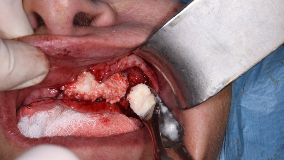 Obr. 8a, b: Druhá horizontální augmentace na pravé straně (a) a na levé straně (b) s již zavedenými implantáty.