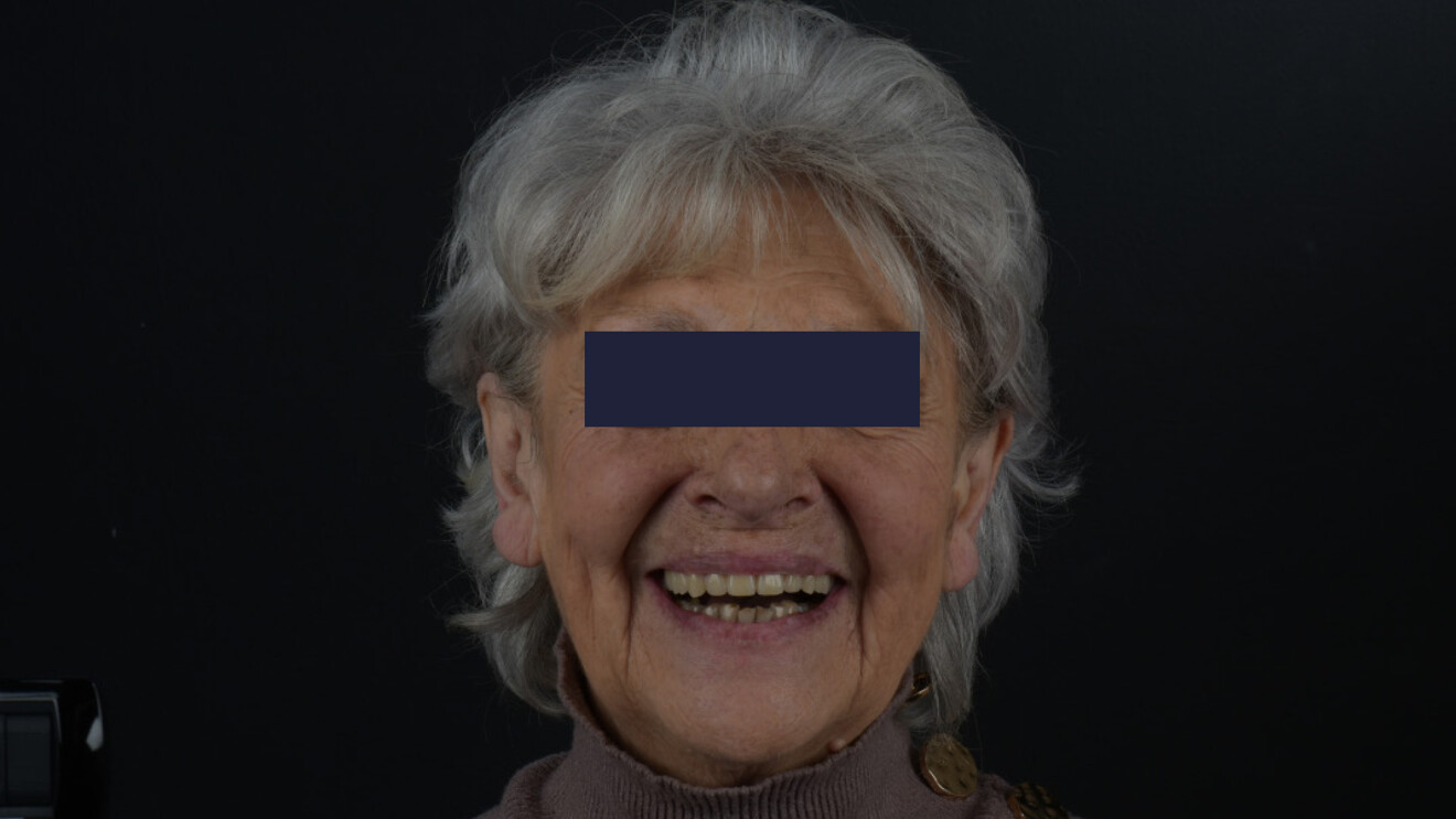 Fig. 25_Sorriso della paziente durante una successiva visita di controllo, evidenziando la soddisfazione estetica.