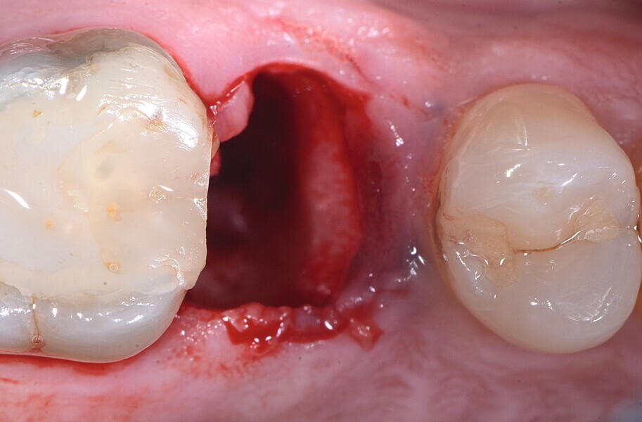 Fig. 15 : Extraction atraumatique.