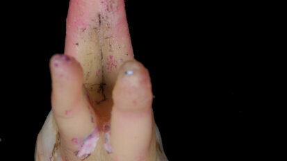 Cracking the code of fractured teeth