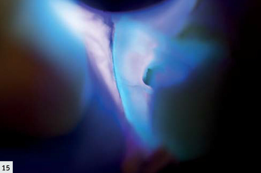 Fig: 15 : Vue rapprochée d’une limite marginale de la restauration. Un petit espace est visible sous forme d’une ligne violette, adjacente à la restauration fluorescente bleuâtre. 