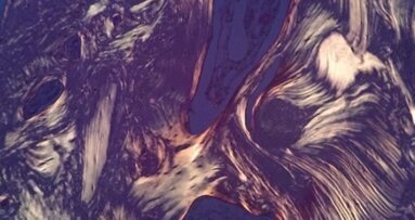 Jednoetapowe hydrokinetyczne podniesienie dna zatoki szczękowej z wykorzystaniem kwasu hialuronowego