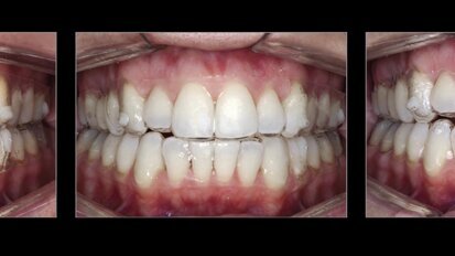 Estética y blanqueamiento dental en la era digital  (Capítulo 16)