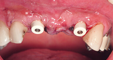 Primaire stabiliteit en osseo-integratie in beschadigde esthetische gebieden